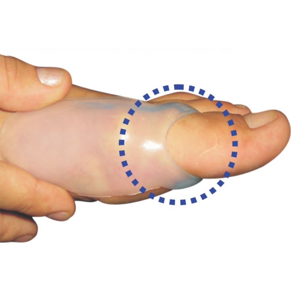 Protetor para Joanete com Alça Siligel 4011 X